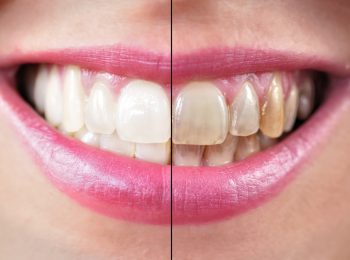 Tooth whitening before and after